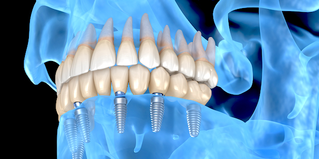 Une nouvelle  étude démontre la possibilité de fusionner implant dentaire et auditif