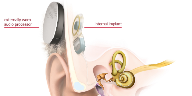 1ère pose d’un implant cochléaire totalement implantable