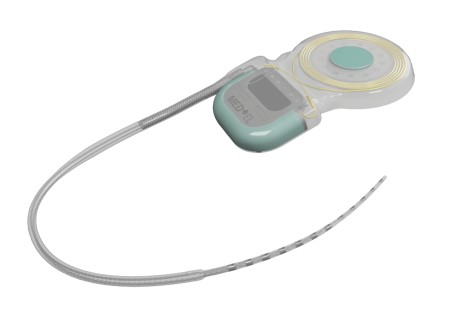 MED-EL : une étude européenne analyse un nouveau type de porte-électrodes d’implant cochléaire