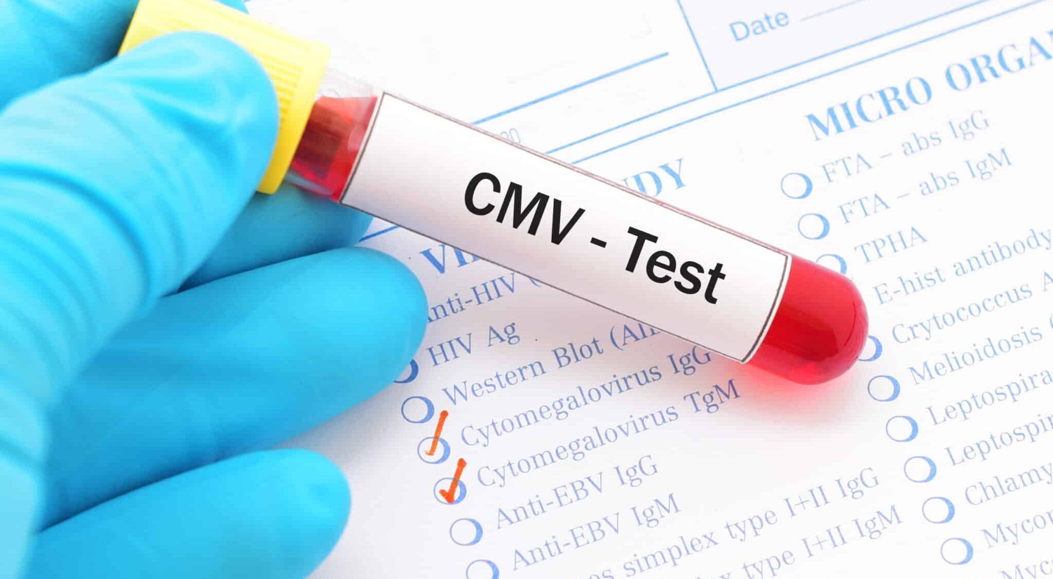 Surdité : vers un dépistage systématique du cytomégalovirus (CMV) ?