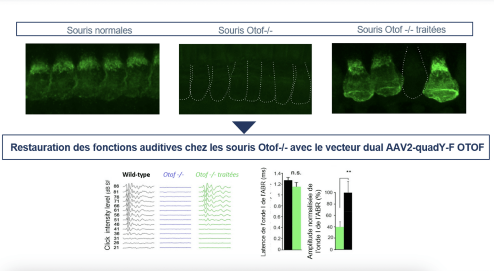 Audiogene, le premier essai clinique de thérapie génique en France a été autorisé